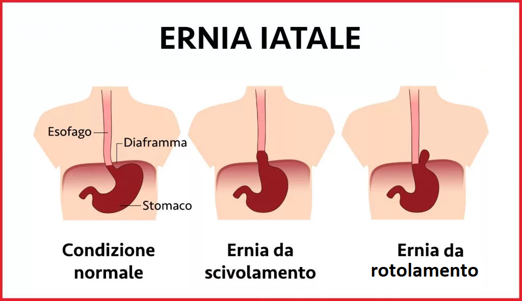 ERNIA IATALE 