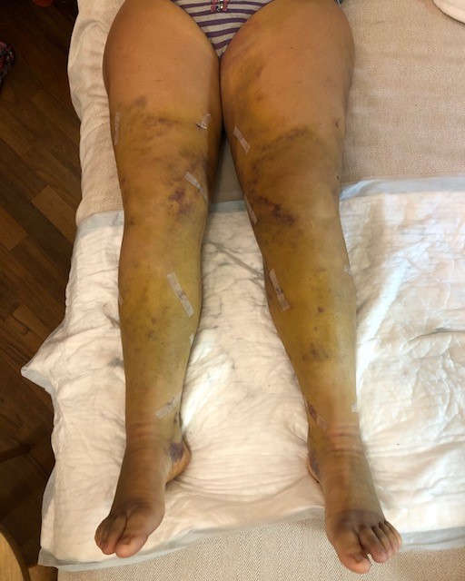 terapia del lipedema